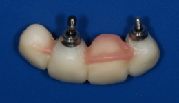 Implant Bridge